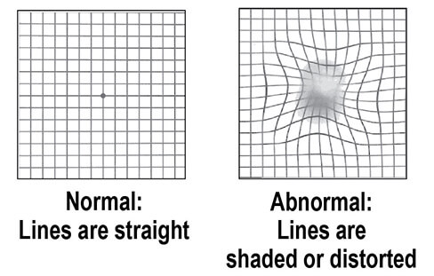 Canadian Association of Optometrists on X: Early signs of  #maculardegeneration can include waviness, distortion, blurring or missing  areas on the Amsler grid. These changes may indicate a problem or worsening  of #AMD.